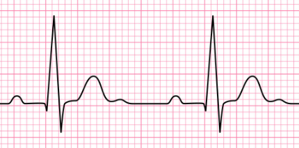 心电图简单图示图片